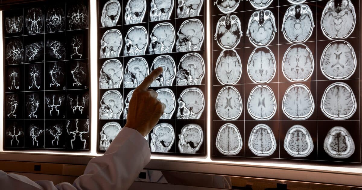Zaburzenie schizoafektywne - objawy, diagnoza i leczenie